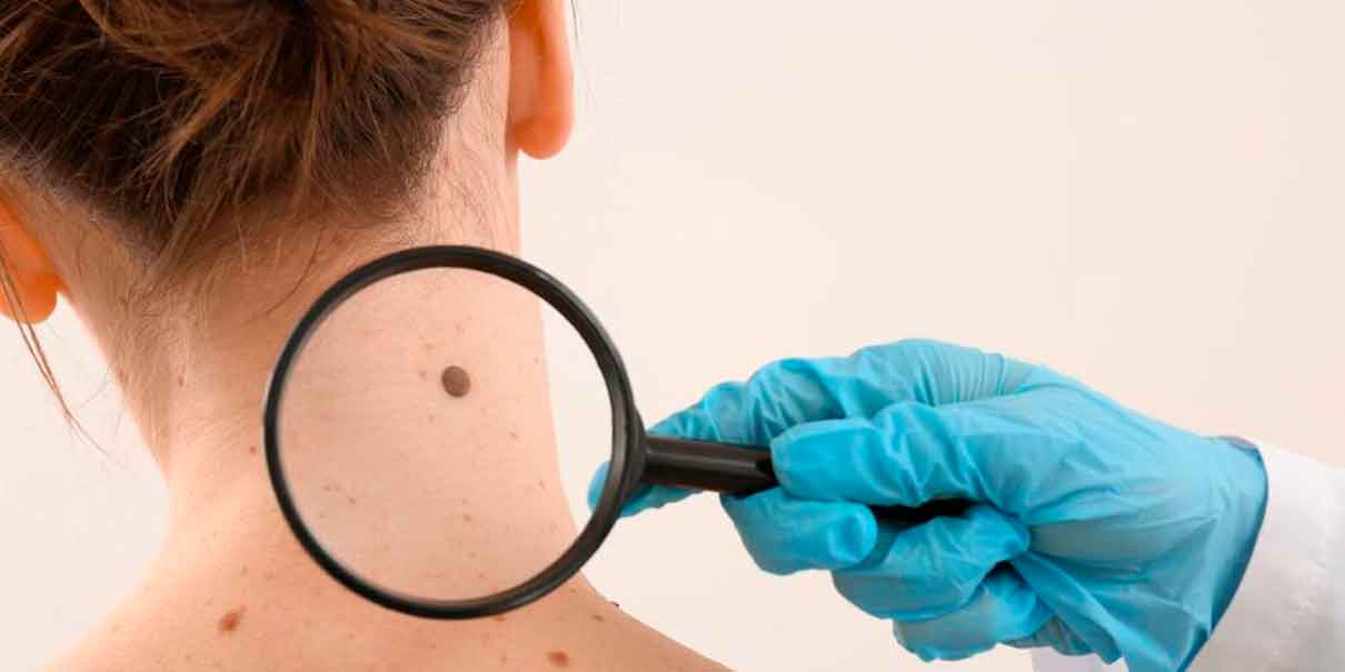 ¿Es un lunar normal? Los cambios en la piel que podrían alertar sobre cáncer