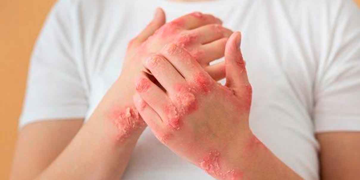 Sífilis: síntomas, cómo prevenirla y qué hacer ante una infección