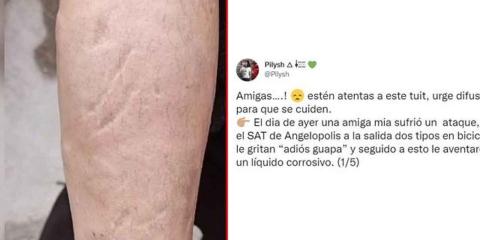 Dos sujetos arrojaron ácido a una mujer que salía del SAT de Angelópolis, en Puebla