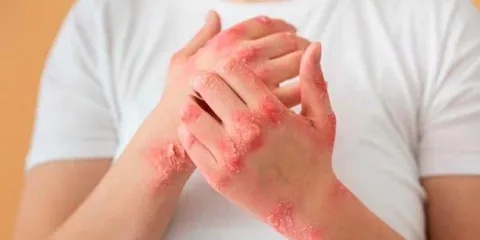 Sífilis: síntomas, cómo prevenirla y qué hacer ante una infección